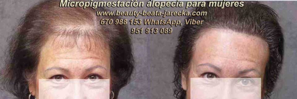 MICROPIGMENTACIÓN CAPILAR MUJERES en MARBELLA y MÁLAGA