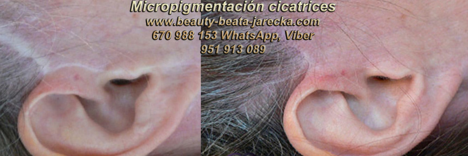 camuflaje de cicatrices |TRATAMIENTO DE LAS CICATRICES