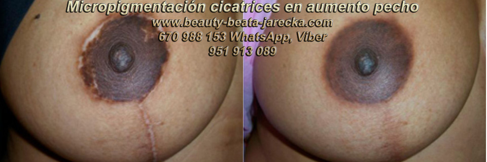 Tratamiento Cicatriz pecho | Cicatriz Cáncer de mamas 