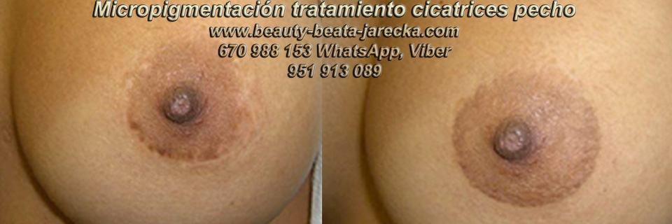 Tratamiento Cicatriz pecho | Cicatrices despues reduccion mamaria