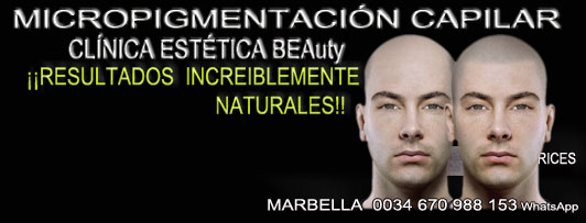 MICROPIGMENTACIÓN CAPILAR MARBELLA Y MÁLAGA